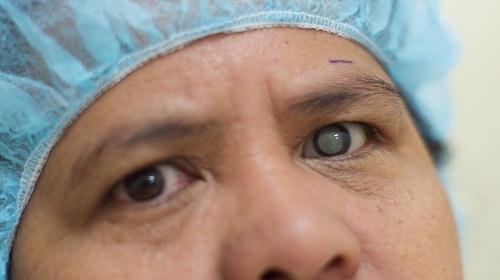 bệnh đục thủy tinh thể các bệnh về mắt