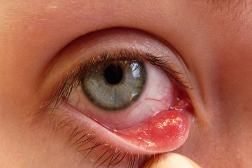 bệnh đau mắt hột trong các bệnh về mắt